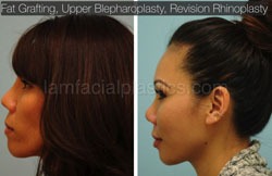 Fat Grafting Before & After