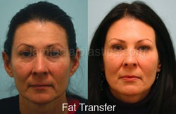 Fat Grafting Before & After
