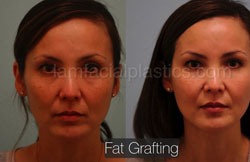 Fat Grafting Before & After