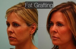 Fat Grafting Before & After