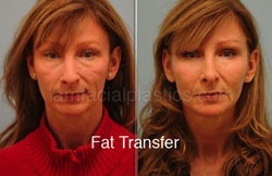 Fat Grafting Before & After
