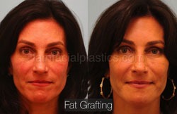 Fat Grafting Before & After