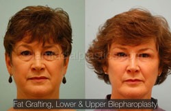 Fat Grafting Before & After