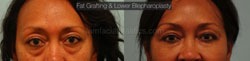 Fat Grafting Before & After