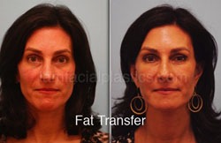 Fat Grafting Before & After