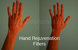 Fillers Before & After