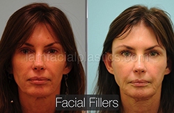 Fillers Before & After