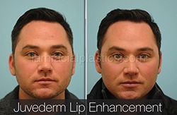 Fillers Before & After