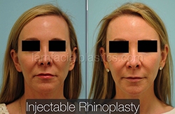 Fillers Before & After