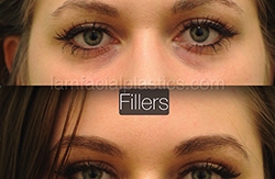 Fillers Before & After