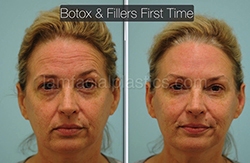 Fillers Before & After