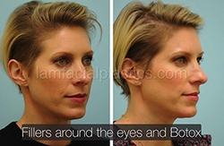 Fillers Before & After