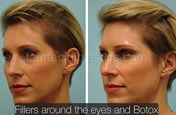 Fillers Before & After