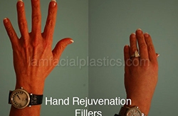Fillers Before & After
