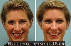 Fillers Before & After