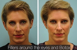 Fillers Before & After