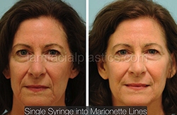 Fillers Before & After