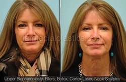 Fillers Before & After