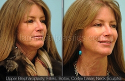 Fillers Before & After