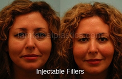 Fillers Before & After