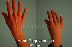 Fillers Before & After
