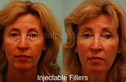 Fillers Before & After