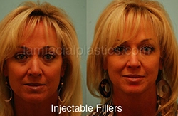 Fillers Before & After