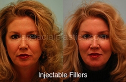Fillers Before & After