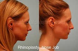 Fillers Before & After
