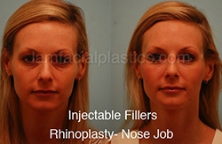 Fillers Before & After