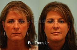Fillers Before & After