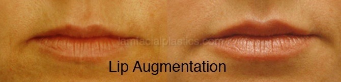 Fillers Before & After