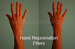 Fillers Before & After