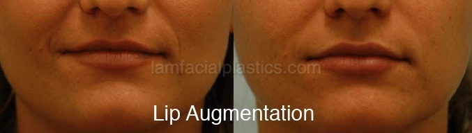 Fillers Before & After