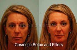 Fillers Before & After