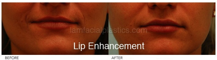 Fillers Before & After