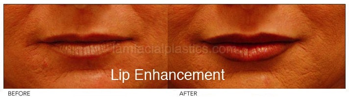 Fillers Before & After