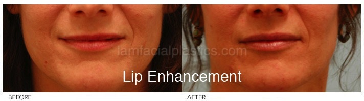 Fillers Before & After