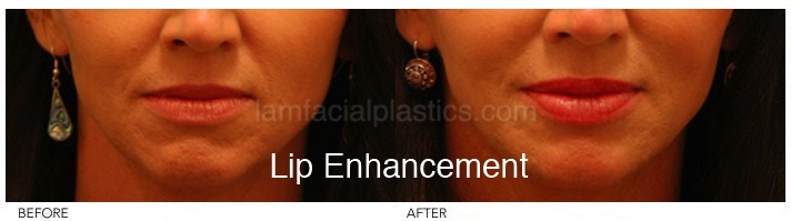 Fillers Before & After