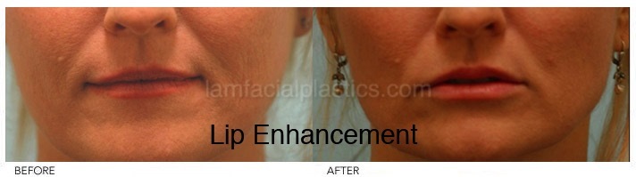 Fillers Before & After