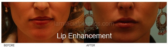 Fillers Before & After