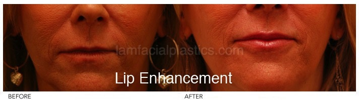 Fillers Before & After