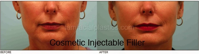 Fillers Before & After