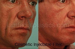 Fillers Before & After
