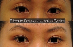 Fillers Before & After