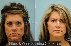 Fillers Before & After