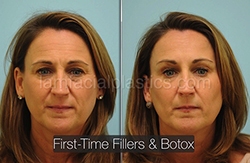 Fillers Before & After
