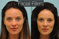 Fillers Before & After