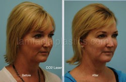Laser Skin Resurfacing Before & After