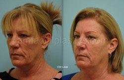 Laser Skin Resurfacing Before & After